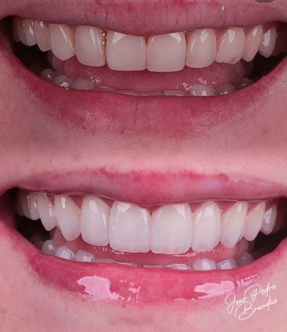 Caso real de facetas em porcelana, antes e depois, tratamento com Dr. João Pedro Brandão