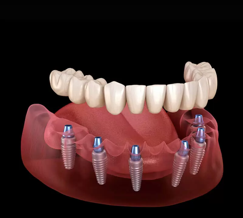 Ilustração 3D de um implante dentário de titânio com coroa